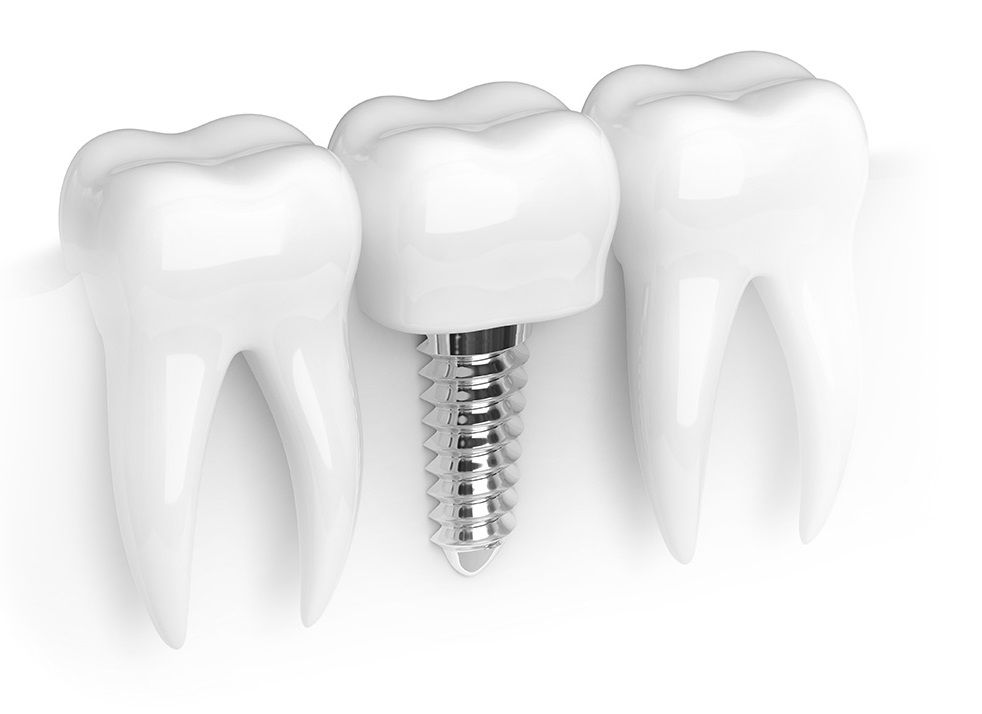 Имплант зуба Osstem. Зуб на белом фоне. Стоматология импланты. Импланты на белом фоне. Сена зуб